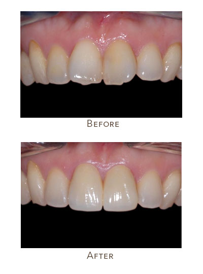 protruding teeth before after