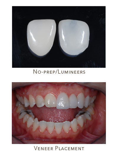 anterior Lumineers or no prep veneers for small teeth