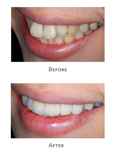 protruding teeth before after