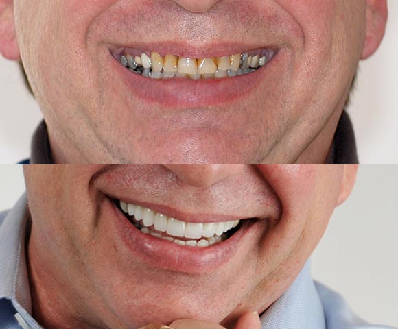 Worn teeth restore