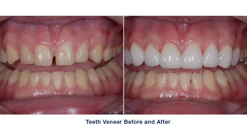 Dental veneers before after