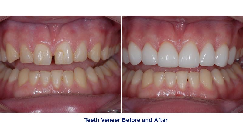 teeth whitening when you have veneers