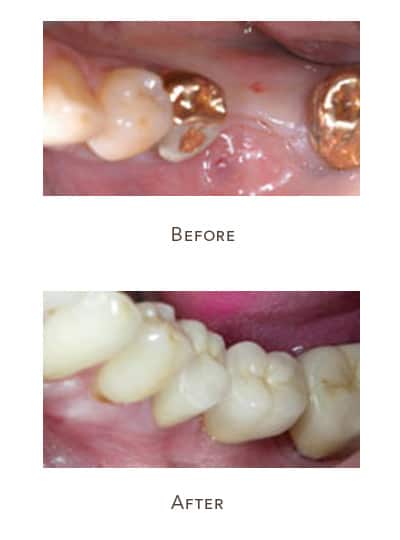 implant teeth