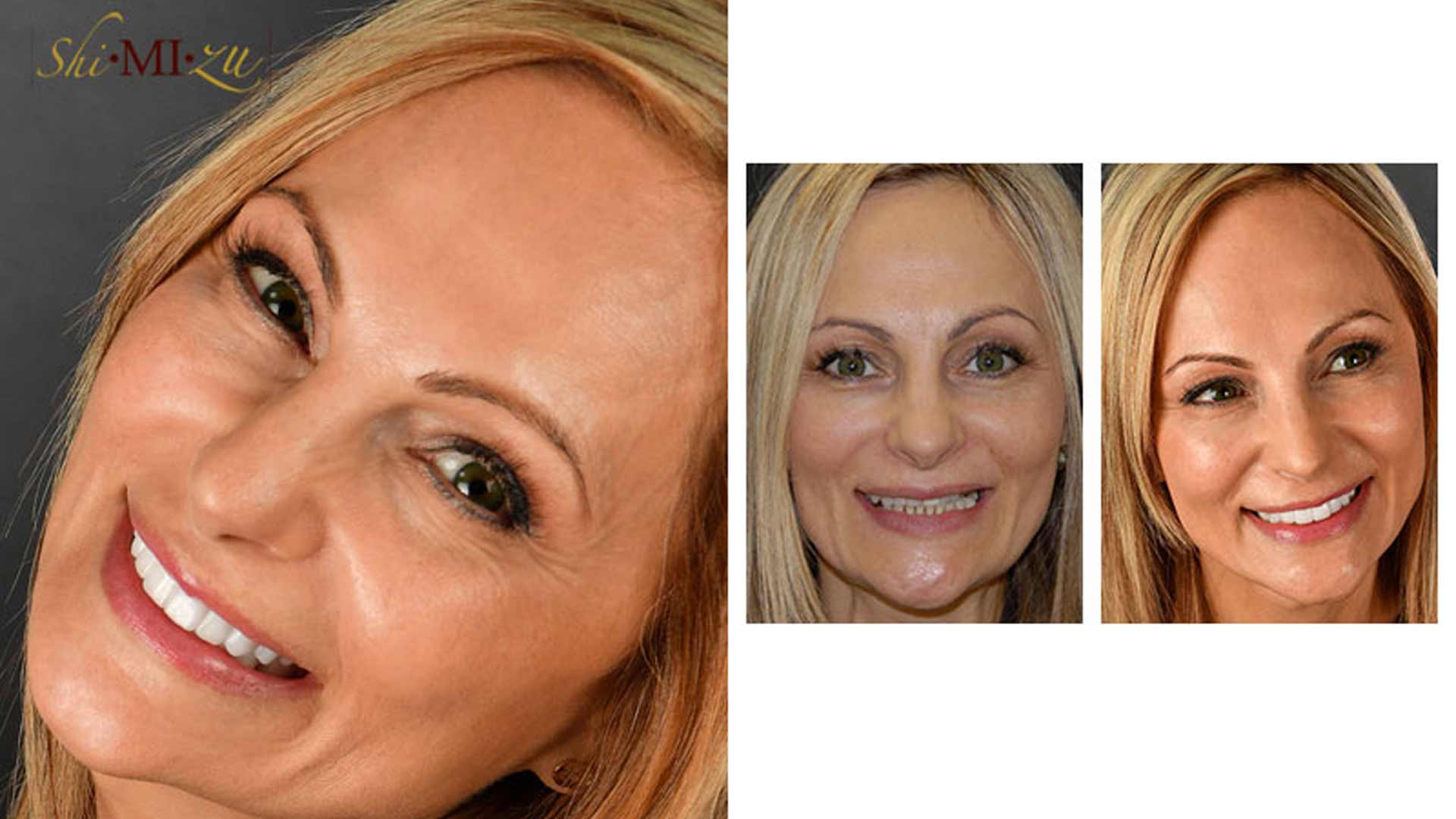 full mouth reconstruction g
