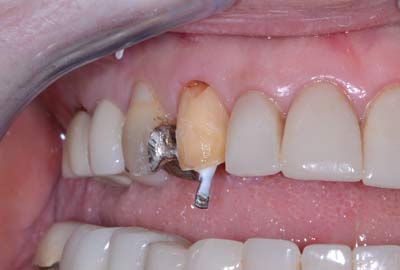 dental post after root canal