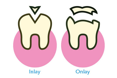 Tooth Colored Restorations and Seamless dental restorations