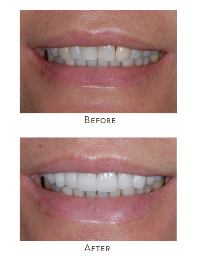 asymetrical teeth color and shapes before after