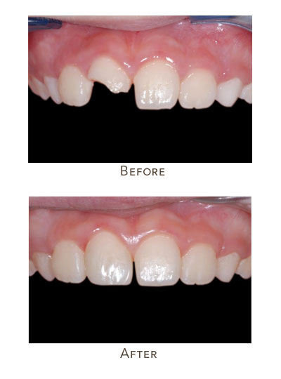 child's broken front insisor tooth before and after