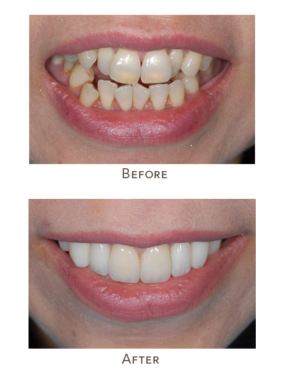 crowded teeth before and after: upper congested teeth repair