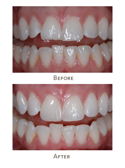 Dental Bonding Cost - Cosmetic Bonding Treatment