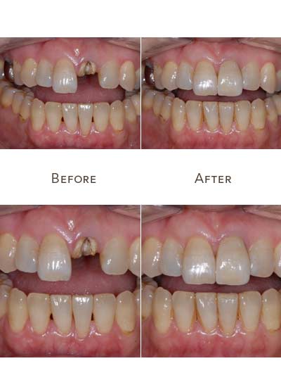 front upper tooth replacement before after