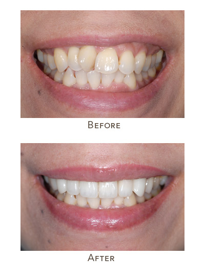 Clear Aligners: Perfect Solution For Straight Teeth