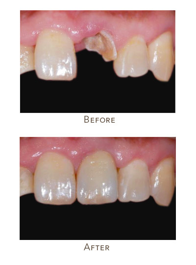 missing tooth color matching to existing teeth