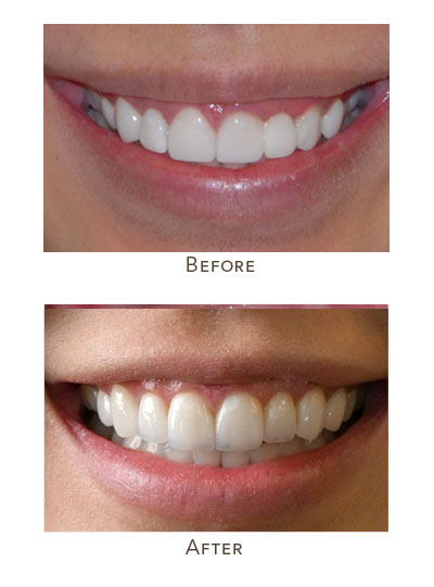 porcelain veneers looks like natural teeth while no-prep veneers looks artificial