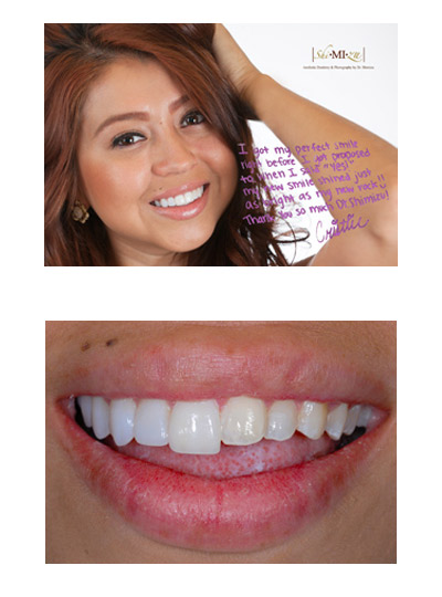 no prep veneers before after