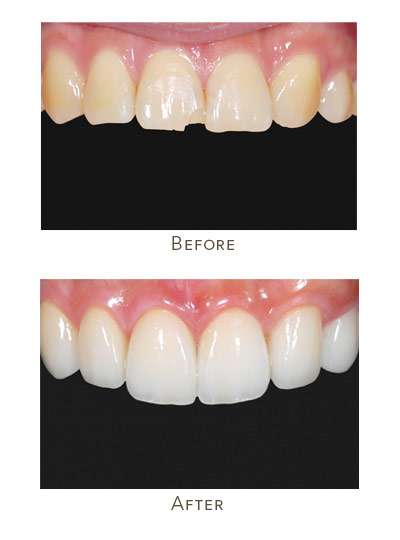 porcelain veneers before after