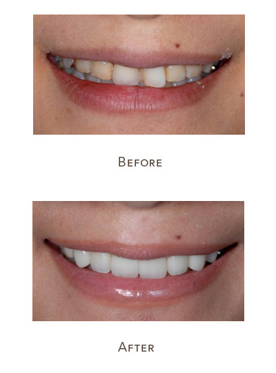 Cosmetic Dentistry What is it | Improve teeth appearance