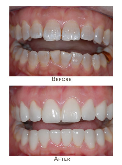 teeth discoloration treatment before after