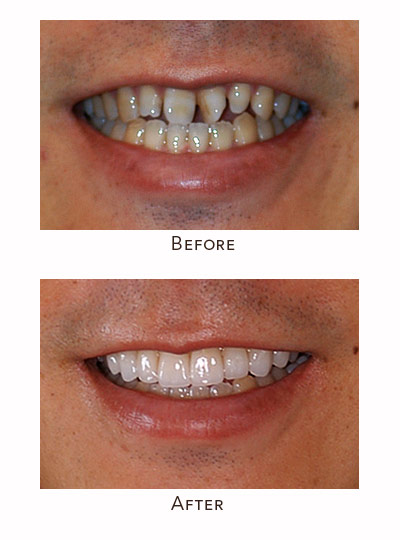 twisted teeth before after