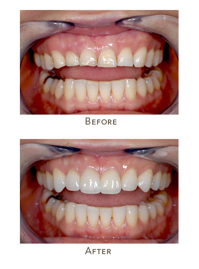 fix upper front teeth differences in length