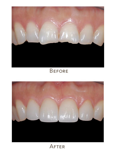 fix uneven front teeth shape and length