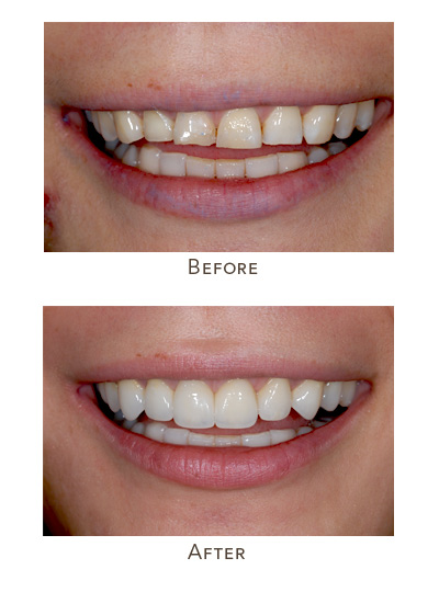 worn upper front teeth length changes