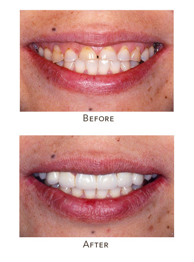 worn down incisors restoration with veneers