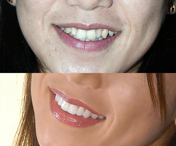 fix crooked front teeth