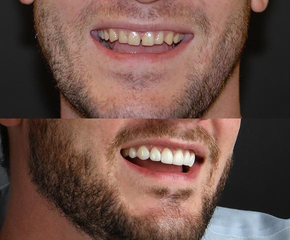 small or spaced out teeth