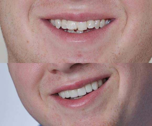 overlapping front teeth fix
