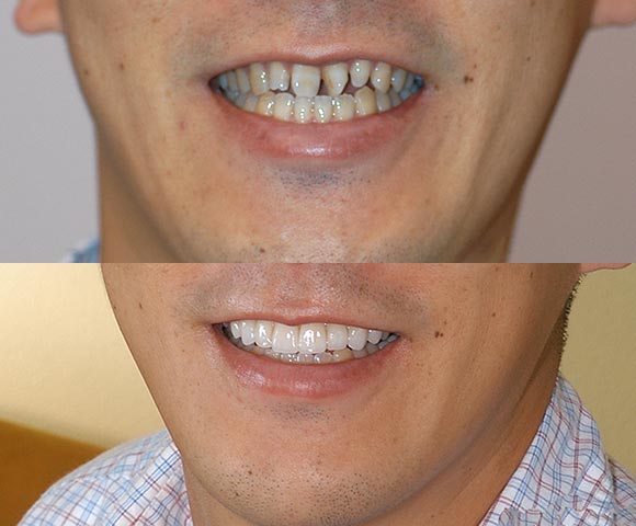 fix spaced out and crooked front teeth