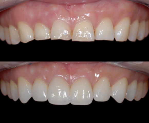 repair uneven teeth length
