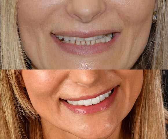 dental reconstruction befor and after