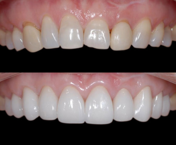 fix uneven gum line and tooth shapes