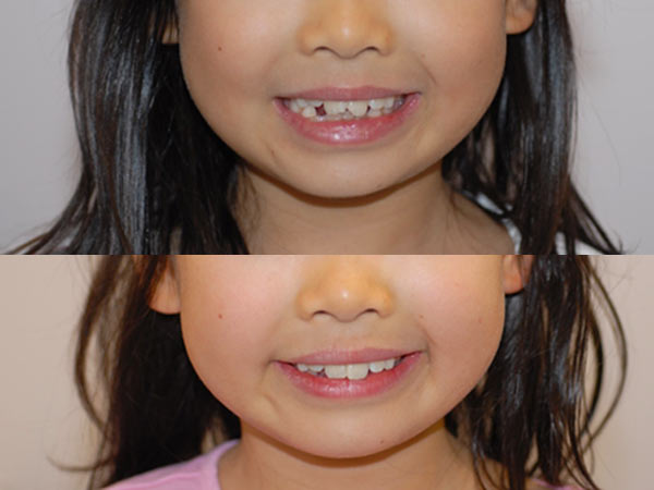 veneers applied to child's teeth