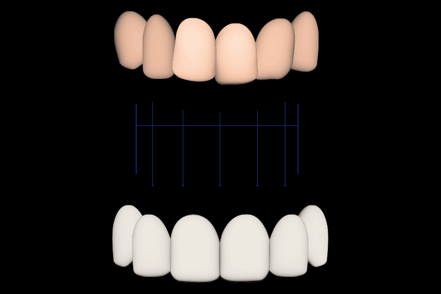 dental crowding treatment with veneers