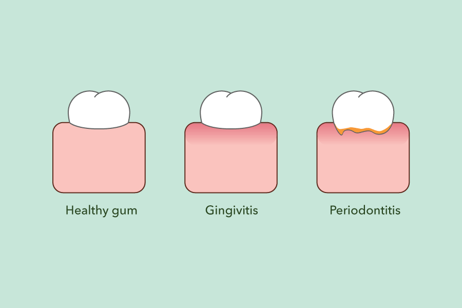 gum infection stages