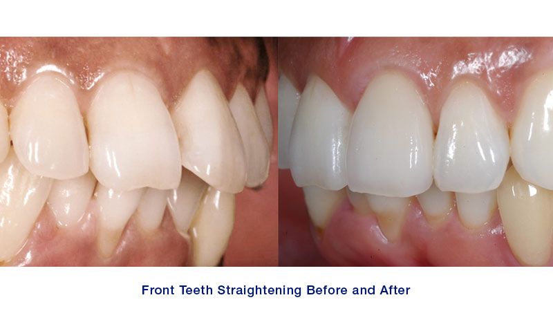 straighten one or two crooked teeth
