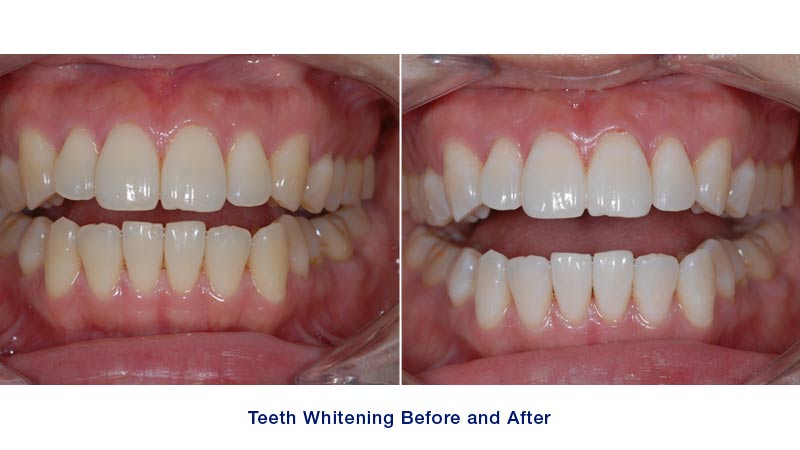 Teeth whitening before after