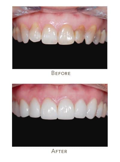 Before & After Image of Teeth Discoloration Treatment West Houston TX
